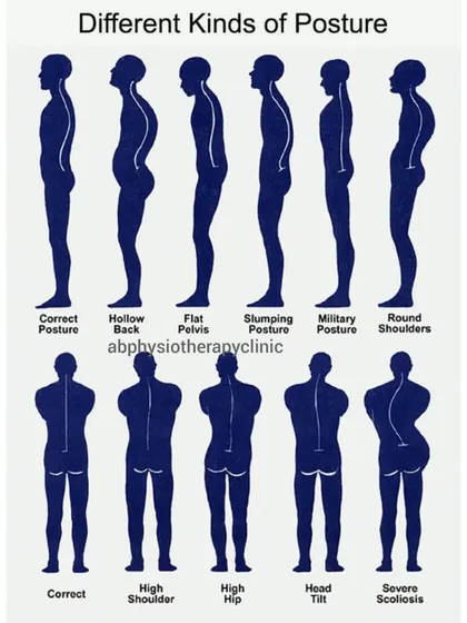 Your posture has a huge impact on your overall health. This chart illustrates various postural problems, such as a hollow back, high hip, or severe scoliosis, which we can help correct through targeted physiotherapy.