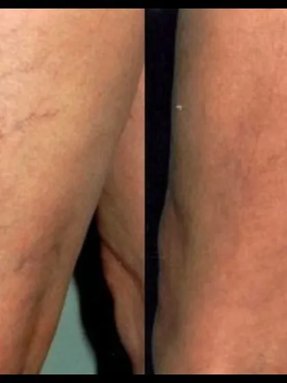 This before-and-after shows the successful treatment of spider veins on the legs using microsclerotherapy. This minimally invasive procedure involves injecting a solution that causes the small veins to collapse and fade away over time.