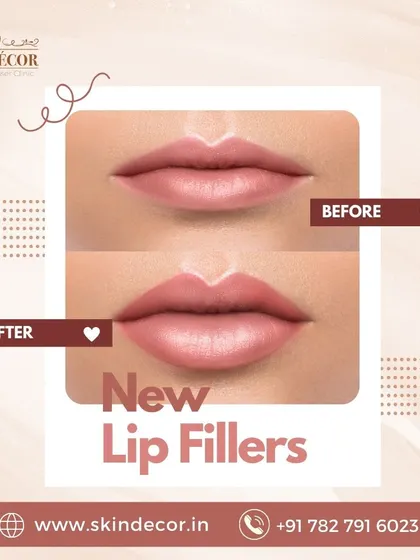 A before and after look at the subtle, natural enhancement achieved with our new lip fillers. My goal is always to restore balance and volume for a result that boosts confidence while looking like you.