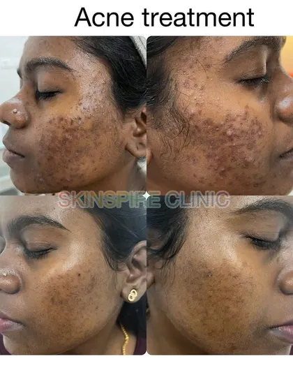 This patient's journey involved managing breakouts and improving skin texture. Notice the reduction in both active pimples and older marks, leading to smoother, clearer skin.