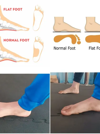 Our coaching goes beyond martial arts. We focus on holistic development, including corrective exercises for issues like flat feet. This before-and-after shows significant improvement in a student's foot posture, which is crucial for long-term athletic health.