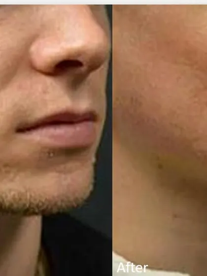 For male patients concerned with deep acne scarring, MNRF is an excellent option. This result shows a significant improvement in skin texture and a reduction in the shadowing caused by pitted scars, leading to a much smoother appearance.