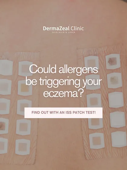 The ISS Patch Test is my primary tool for discovering the root cause of allergic eczema. This image shows the patches applied to a patient's back, each containing a potential allergen to test the skin's reaction.