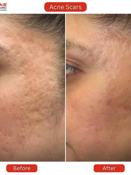 Here we addressed a combination of ice pick and boxcar scars. The "after" image shows a refined skin texture with shallower scars and a healthier overall appearance.