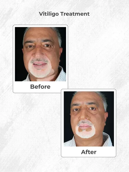 Vitiligo requires a specialized and patient approach. This before and after shows the progress of a vitiligo treatment, helping to restore pigment and confidence.