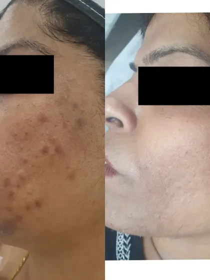 Here you can see a dramatic improvement in post-inflammatory hyperpigmentation (PIH), where dark spots from old acne have faded to reveal a clearer, even complexion.