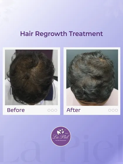 Here you can see the results of a targeted hair regrowth treatment for male pattern thinning. We successfully increased hair volume and scalp coverage, leading to a fuller and healthier appearance.