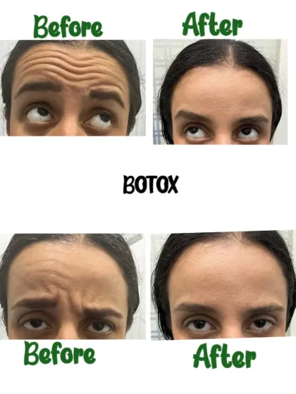 A side-by-side comparison showing the significant reduction of deep-set forehead lines and frown lines after a Botox treatment. The 'after' image displays a smooth, relaxed forehead, demonstrating a refreshed and more youthful appearance while maintaining natural expression.