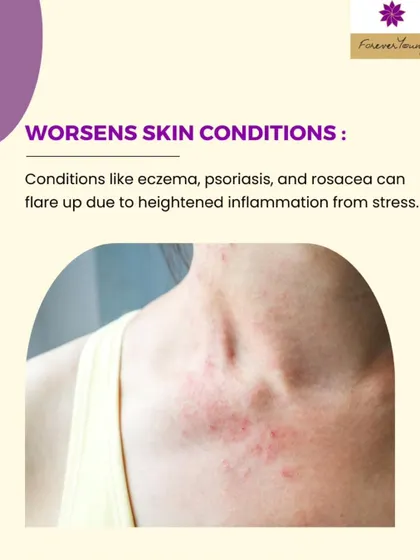 If you have underlying skin conditions like eczema, psoriasis, or rosacea, stress can be a major trigger for flare-ups. The heightened inflammation in the body makes these conditions worse.