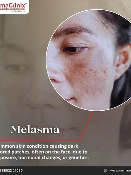 This image shows Melasma, a common skin condition causing dark, discolored patches, often due to sun exposure or hormonal changes. We offer specialized treatments for this concern.