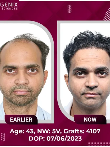 See the transformation of a 43-year-old with Grade 5V baldness, restored with 4107 grafts for a natural, lasting result.