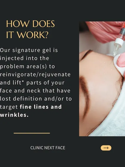 How does the Organic Lift work? Our signature gel is injected into problem areas to rejuvenate and lift parts of your face and neck that have lost definition. It is also highly effective for targeting fine lines and wrinkles.