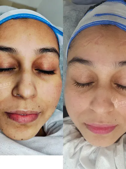 A fantastic result from Millifrac treatment, showing a visible reduction in dullness and uneven texture, replaced by a brighter, more vibrant complexion.