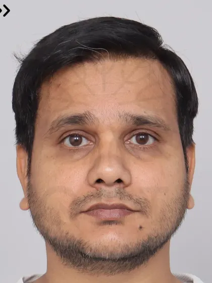 This Norwood Grade 4A patient's 14-month transformation after a single session with 4000 grafts. We restored his hairline and frontal region for a fuller, more confident look.