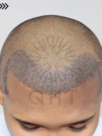 Fresh graft placement for a Grade 2 case. We used 2400 grafts to recreate the hairline, enhance the frontal region, and design natural temples.