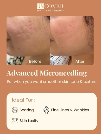 This before-and-after shows the power of advanced microneedling for improving skin tone and texture. It's an ideal treatment for scarring, fine lines, and skin laxity.