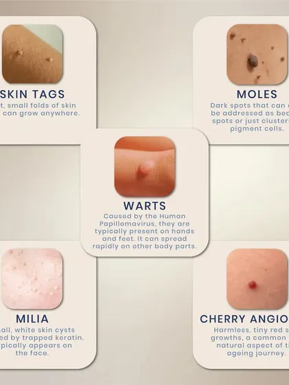 Let's decode common skin growths. This guide explains the differences between skin tags, moles, warts, milia, and cherry angiomas, helping you understand what's on your skin.