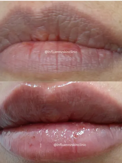 This image shows how lip fillers can not only add volume but also smooth out fine lines on the lips for a rejuvenated look.