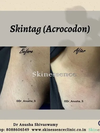 This before and after image shows the result of a skin tag removal procedure in the underarm area. The removal is clean, and the skin heals beautifully without leaving any significant marks, restoring a smooth appearance.