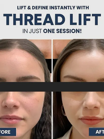 A thread lift offers a fantastic non-surgical option for lifting and tightening the skin. You can see the immediate improvement in facial contours and reduction in sagging in this before and after result.