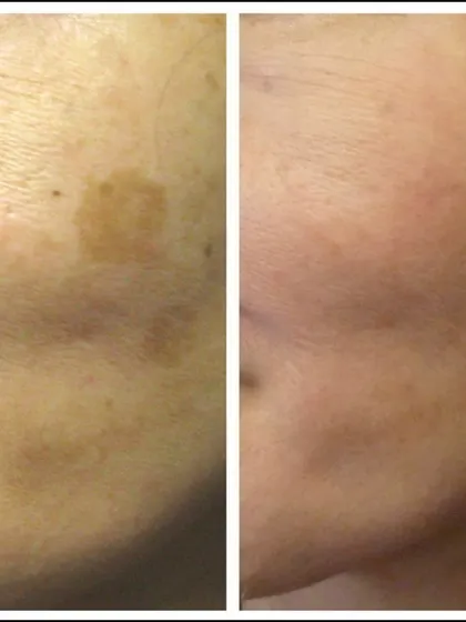 A fantastic result showing the significant lightening of a stubborn patch of pigmentation. This was achieved over several sessions using a combination approach, proving that with patience and the right technique, clear skin is attainable.