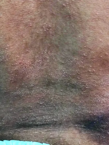 This is Miliaria Crystallina, also known as heat rash or prickly heat, which is common in summer, especially in children. It's caused by blocked sweat ducts and can be managed by wearing loose cotton clothes and applying a light moisturizer.