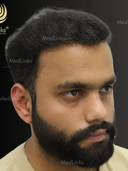 The final result from the side, showcasing a natural and well-defined hairline.