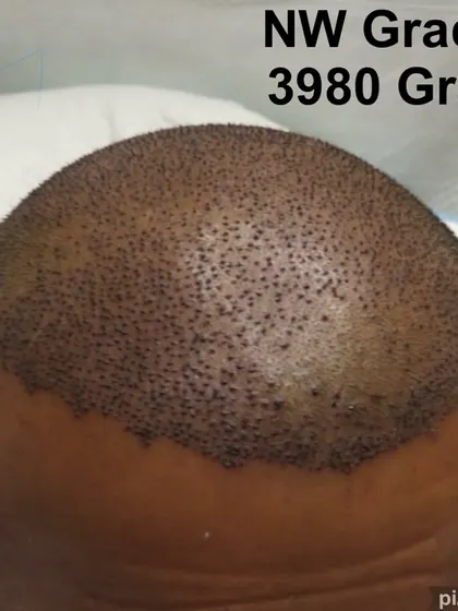 This image shows the immediate post-operative result of a nearly 4000-graft transplant for a patient with Norwood Grade 5 baldness. The hairline has been re-established and the entire balding area has been covered.