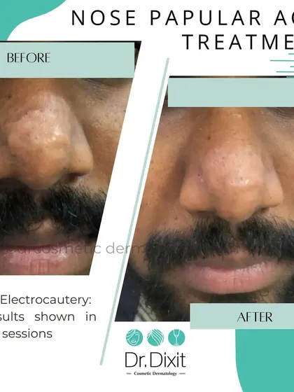 This is a real result from treating papular acne on the nose using RF Electrocautery. This before and after image shows the significant improvement possible with the right procedure. This treatment effectively reduces lesions and improves skin texture over a few sessions.