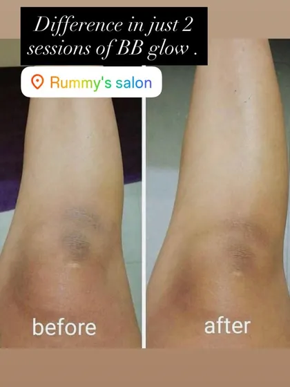 BB Glow isn't just for the face. Here, you can see a noticeable lightening of pigmentation on the knees after just two sessions, demonstrating how the treatment can even out skin tone on the body.
