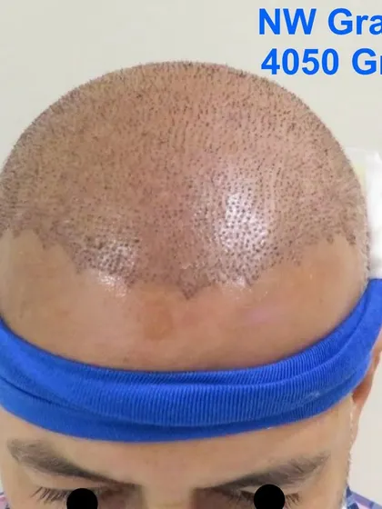 Another successful Giga Session, this time with 4050 grafts to address Grade 5 baldness. These large sessions are cost-effective and provide a complete transformation in a short time frame.