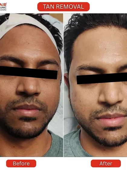 This is a clear example of our effective tan removal treatment. We help restore your skin's natural tone, reversing sun damage to reveal a brighter, healthier complexion. The process is quick, safe, and delivers visible results.