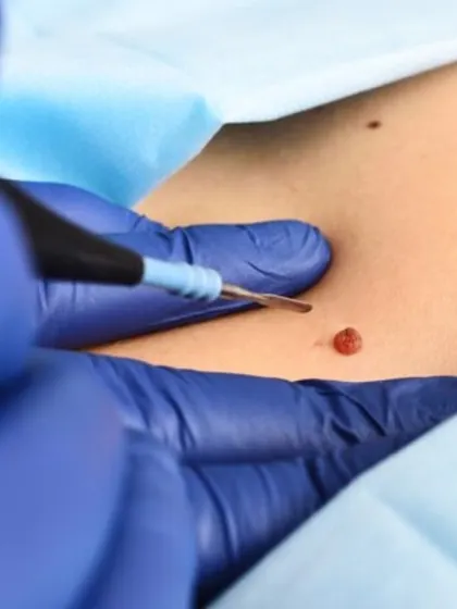 Here you can see the precision of a mole removal procedure using an electrosurgical tool. This technique allows me to remove the growth with minimal impact on the surrounding skin, ensuring a clean outcome and excellent healing.