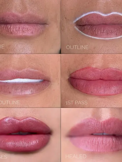 Achieving the perfect, natural-looking lips is a process I take very seriously. This image shows the step-by-step journey of a lip filler treatment, from the initial outline to the final healed result. My goal is always to enhance your natural shape for a balanced and beautiful smile, never to make it look 'done'.