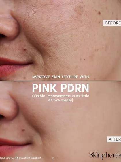 This before and after comparison highlights the skin texture improvement from our Pink PDRN treatment. Notice the visible reduction in pores, fine lines, and unevenness, leading to a smoother and more radiant complexion.