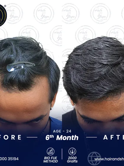 A 2000-graft BIO FUE transplant can make a huge impact. This 6-month result shows a restored hairline and improved density.