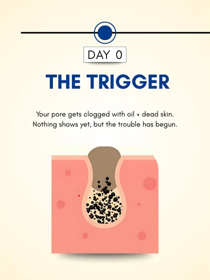 Day 0: The process begins when a pore gets clogged with oil and dead skin cells. At this stage, nothing is visible on the surface, but the foundation for a pimple has been laid.