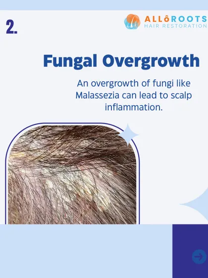 Fungal overgrowth, particularly of a yeast called Malassezia, is a common cause of scalp problems. This can lead to inflammation, dandruff, and an unhealthy environment for hair growth.