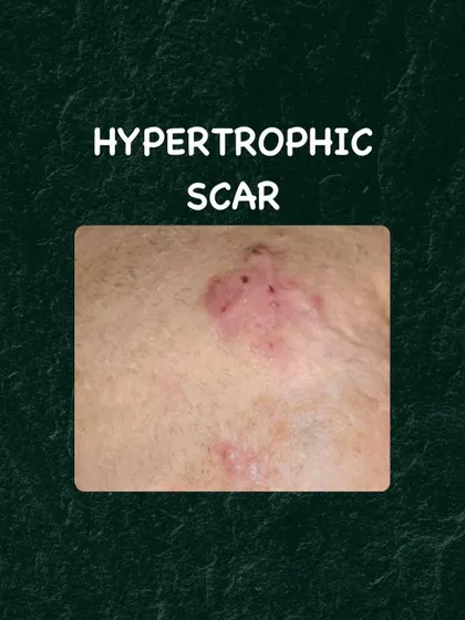 Hypertrophic scars are raised, thickened scars that form when the body produces too much collagen during healing. Treatment may involve steroid injections or silicone sheets.
