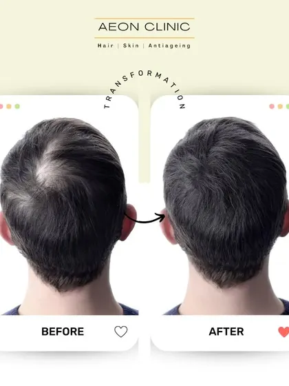 This transformation from the back shows how we effectively address crown balding, creating density that looks completely natural.