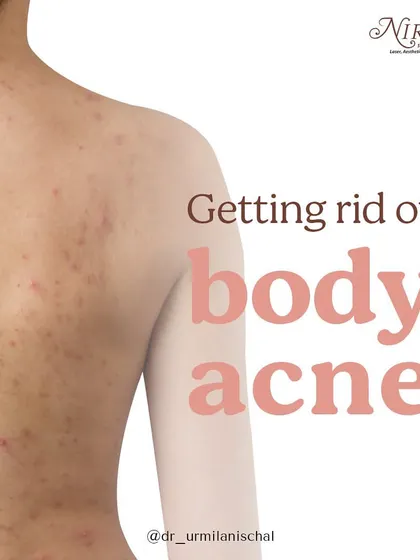 Body acne is a common concern, often appearing on the back and chest. This image introduces a series of tips to help you manage and get rid of these breakouts for clearer, smoother skin.