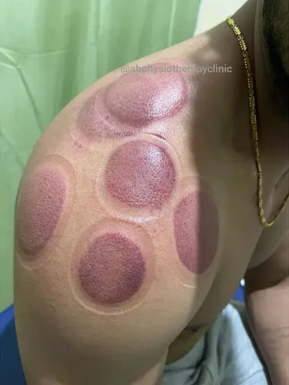 These marks are the result of a successful cupping session for shoulder pain. They show that circulation has been stimulated in tight areas, which is the first step toward reducing soreness and restoring healthy muscle function.
