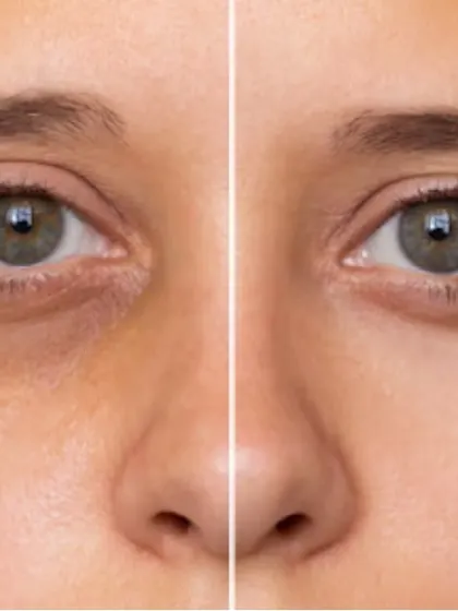 Dark circles are a common concern with multiple causes, including pigmentation, volume loss, and thin skin. My treatment approach is holistic, using peels, lasers, or sometimes fillers to brighten and rejuvenate the delicate under-eye area.