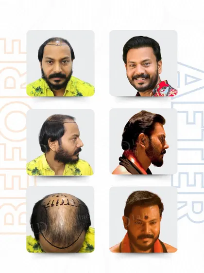 For an actor like Pramod Mani, confidence is key. His case was challenging due to a thin donor area, but with careful planning and the advanced RT-FUE technique, I implanted 5,836 grafts. This shows that even complex cases can achieve incredible, natural-looking density.