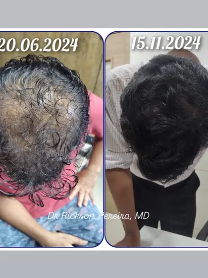 This progress photo, sent to me by a patient, shows a fantastic improvement in hair density over five months. It's always rewarding to see patients achieve results that make them happy and confident.