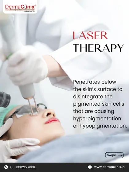 This image shows a laser therapy session for pigmentation. The laser penetrates below the skin's surface to break down pigmented cells that cause hyperpigmentation, leading to clearer skin.