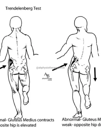 A Trendelenburg gait, where the hip drops when walking, indicates weakness in the hip abductor muscles. This diagram explains the test we use to identify this issue, which is often linked to back or hip pain.