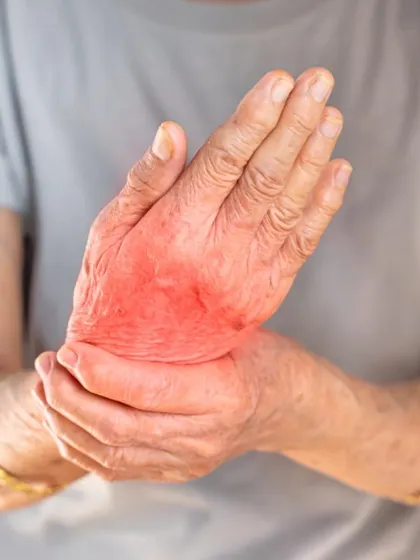 Rheumatoid Arthritis is an autoimmune condition that I treat by focusing on detoxification and pacifying Vata and 'ama' (toxins). Panchakarma therapies like Virechana (purgation) and medicated oil massages help reduce inflammation and rebuild strength in the joints over time.