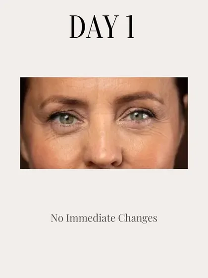 On day one, right after your Botox treatment, there are no immediate changes. The product takes a few days to start working, so patience is key.