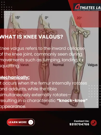 This graphic defines knee valgus mechanically, explaining how the inward collapse occurs due to a combination of femoral internal rotation and tibial external rotation, creating the characteristic "knock-knee" appearance during movements like squats and jumps.